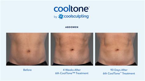 COOLSCULPTING .